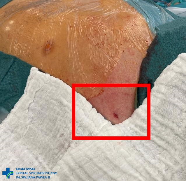 Kolorowe zdjęcie pacjenta z nakłuciem skóry w okolicach obojczyka do wprowadzenia zastawki TAVI