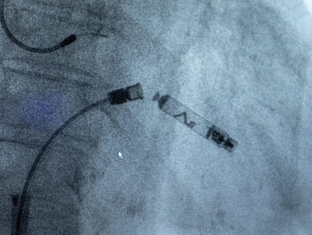 Zdjęcie rentgenowskie a na nim bezelektrodowy rozrusznika serca 