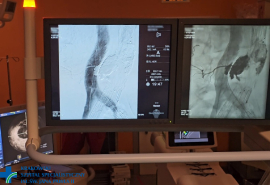 Widok na dwa ekrany przedstawiające widok tętnic